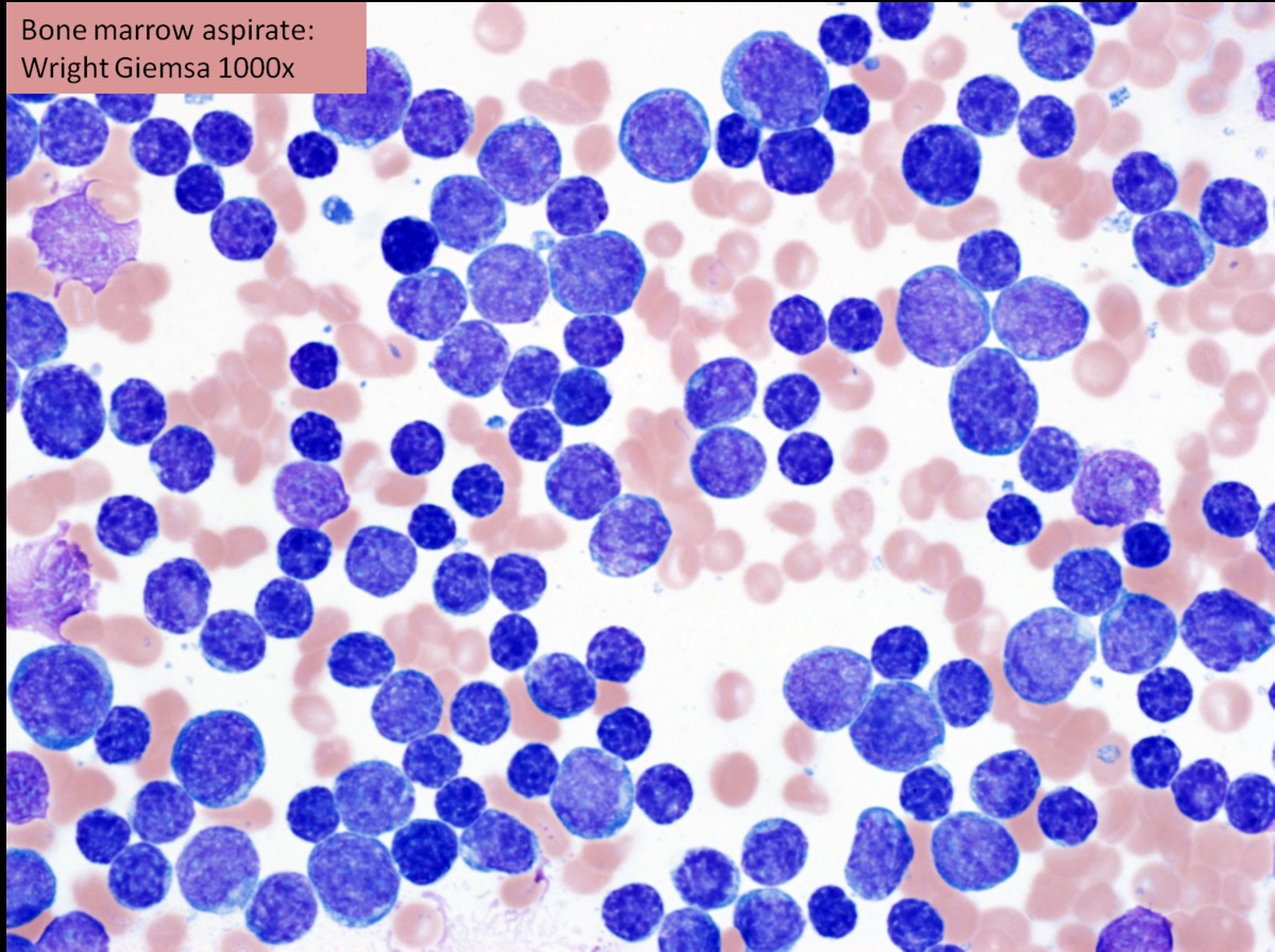 Bone marrow aspirate showing >90% lymphoblasts.